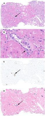 Case report: JC polyomavirus nephropathy in simultaneous heart–kidney transplantation: the role of viral-specific in situ hybridization staining